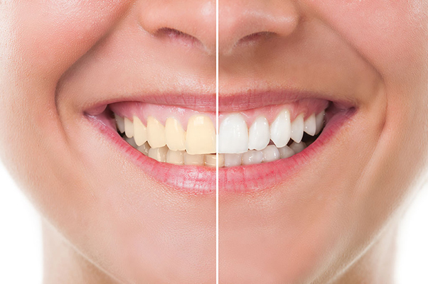 Before and after teeth cleaning